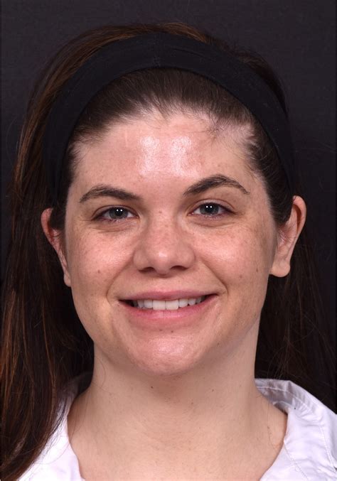 buccal fat removal norge|Ansiktskirurgi – Aviva Helse.
